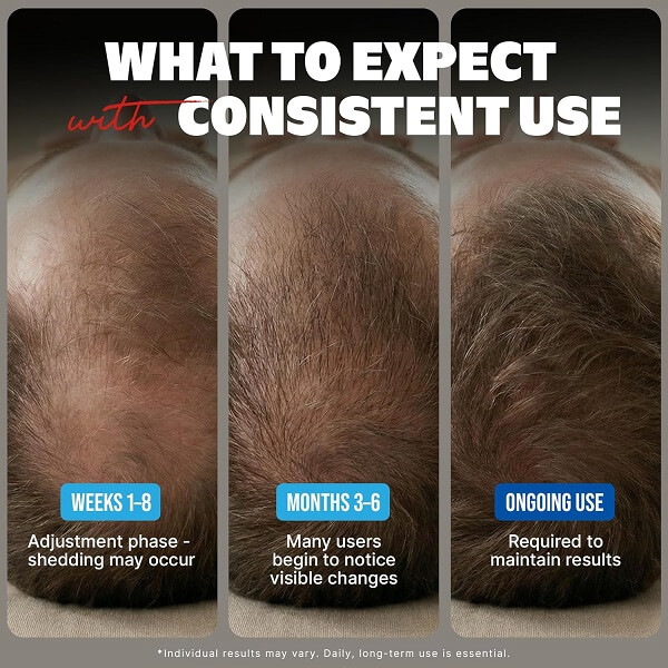Kirkland Signature Minoxidil 5% Extra Strength Topical Solution